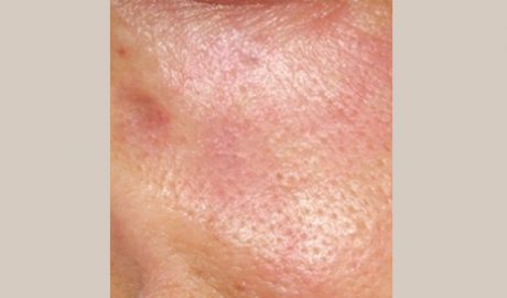 Pigmented Birthmarks & Port Wine Stains Removal | Aesthetipedia.com